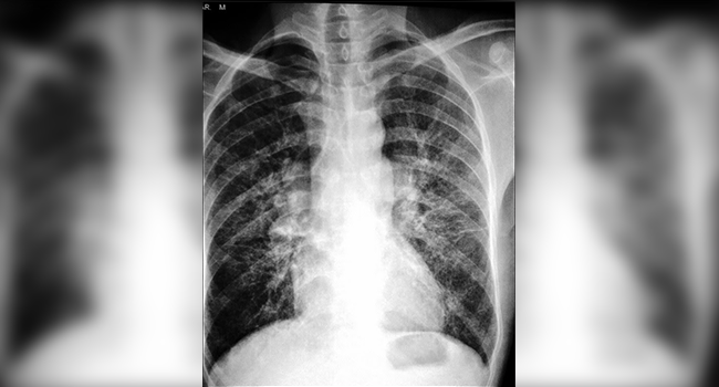 Breathing Infection Hits Hundreds of Palm Oil Workers in Babel